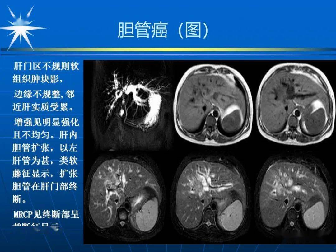 胆总管mri解剖图图片