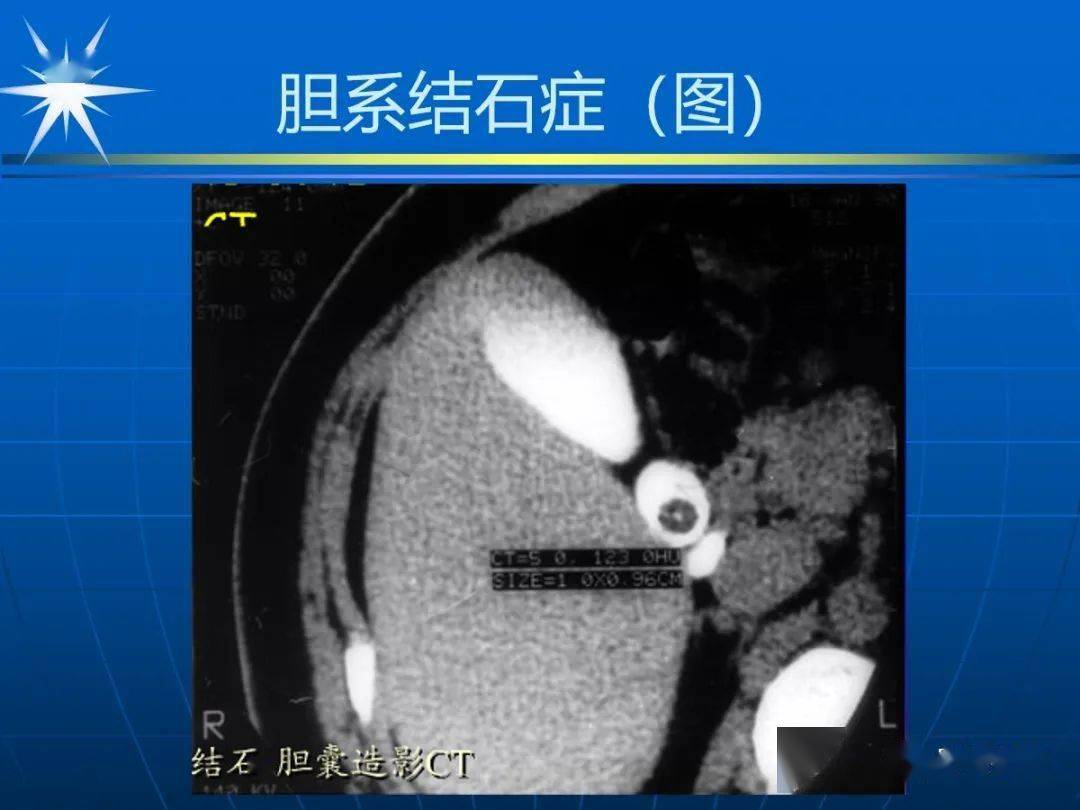 胆总管mri解剖图图片