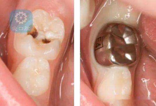 关于儿童乳牙预成冠的临床应用详解看这里