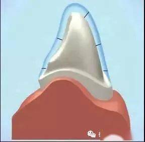 关于儿童乳牙预成冠的临床应用详解看这里