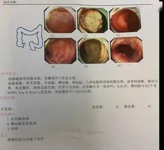 早期肠癌症状不明显,医生提醒:出现6个异常,病情或已到中晚期_检查