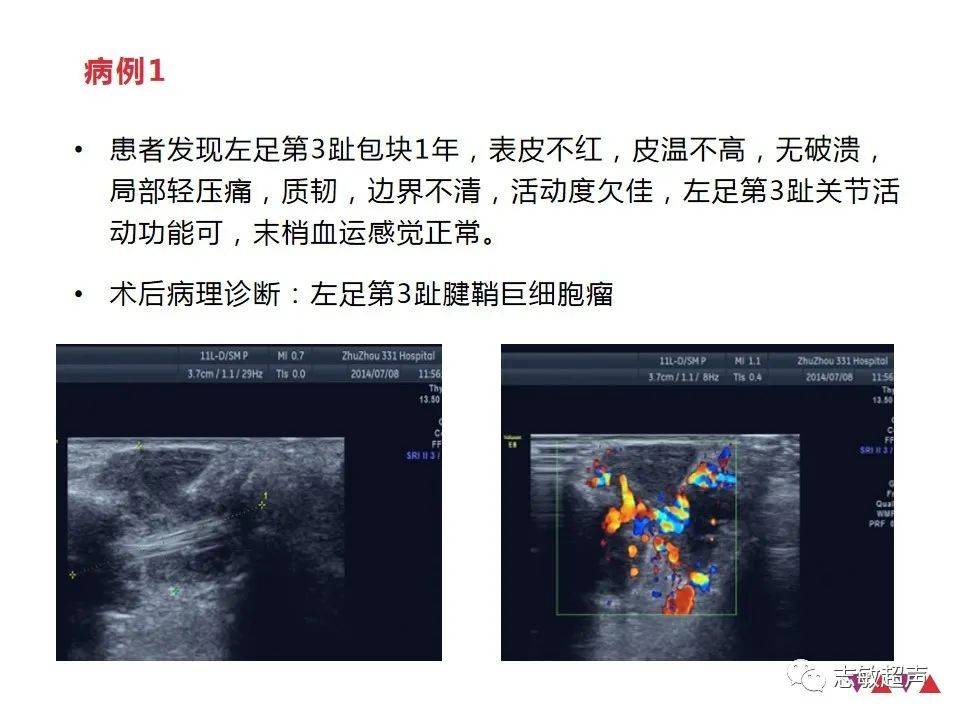 腱鞘鉅細胞瘤