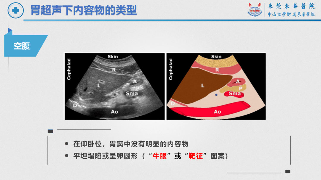 正常胃的超声图像图片