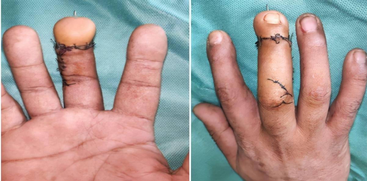 男子施工致手指末节离断手指再造术助他圆残缺之憾