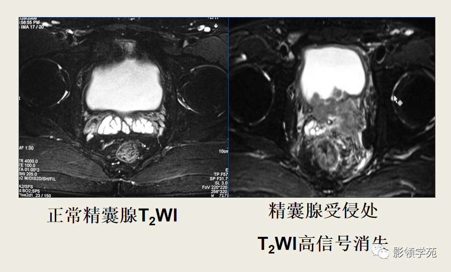 前列腺磁共振图像图片