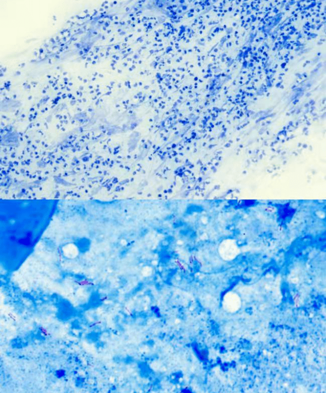 市疾控中心对结核病实验室痰涂片工作进行质量核查