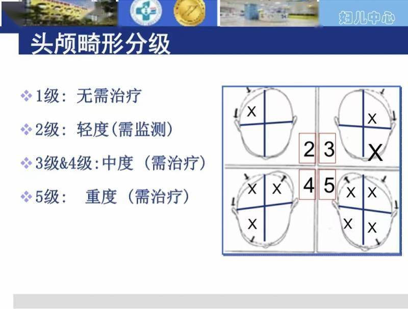利用非接触式激光扫描数据接收系统,对头颅形状进行定量,定性的三维