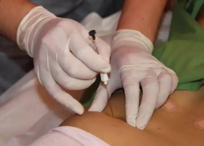 机体|【医文医话】针灸二科：带您了解穴位埋线疗法