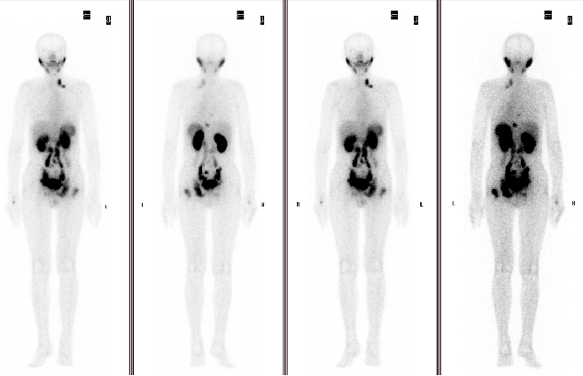 17 psma spect:前列腺癌治疗后,前列腺psma表达略增高同前相仿;左侧