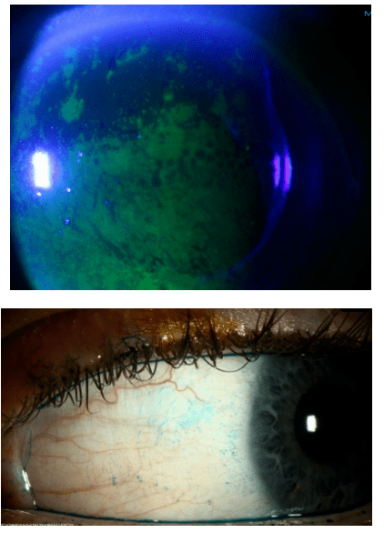 若根据一只眼睛进行评分,中央的角膜染色有0-3分的计分,而角膜旁的鼻