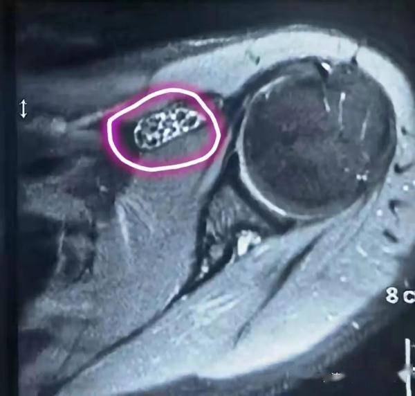 关节|肩关节中长出40多个“关节鼠” 医生微创端“鼠”窝