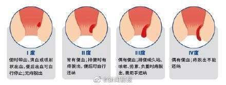 血液|蹲坑玩手机易成有痔青年