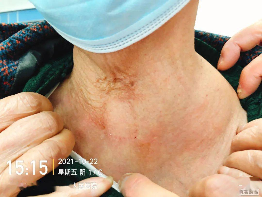 颈部,肩部,胸部,颜面部有水肿症状或体征,超声提示深静脉血栓形成,伴