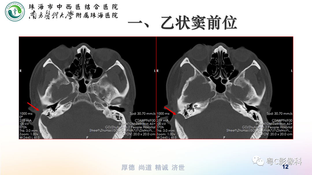 额窦CT图片图片