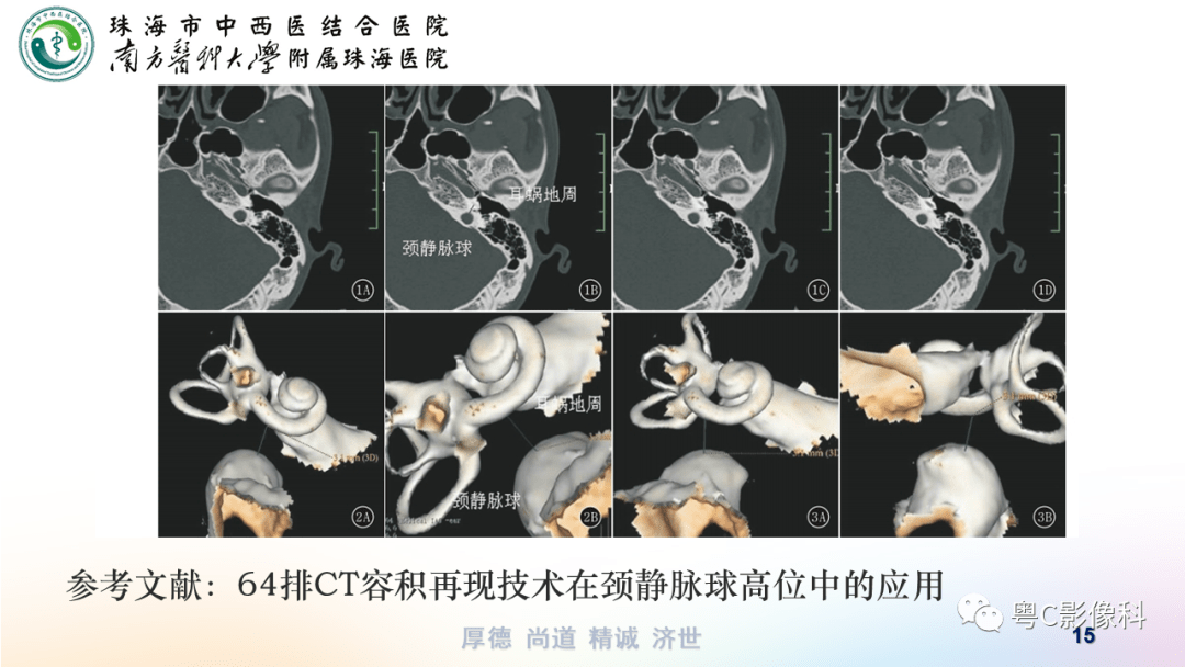 乙状窦解剖图ct图图片