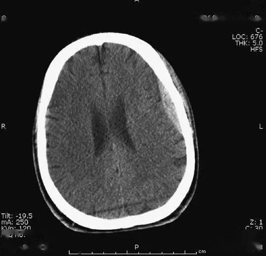右侧大脑水肿,中线结构移位▲(小脑幕下)硬膜下血肿▲(大脑镰左侧)