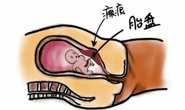 "心"技术丨瘢痕子宫孕妈如愿在淄博市妇幼保健院平安顺产