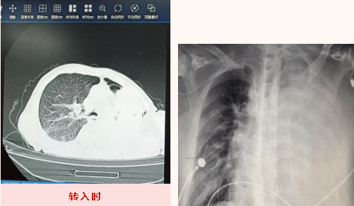 肺泡|莱州市中医医院运用床旁纤维支气管镜治疗重症肺不张患者一例