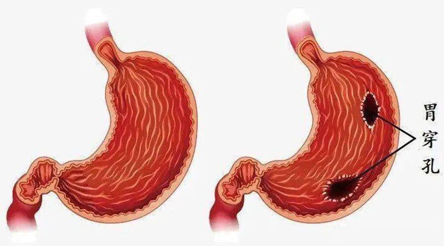 胃穿孔诊断书图片高清图片
