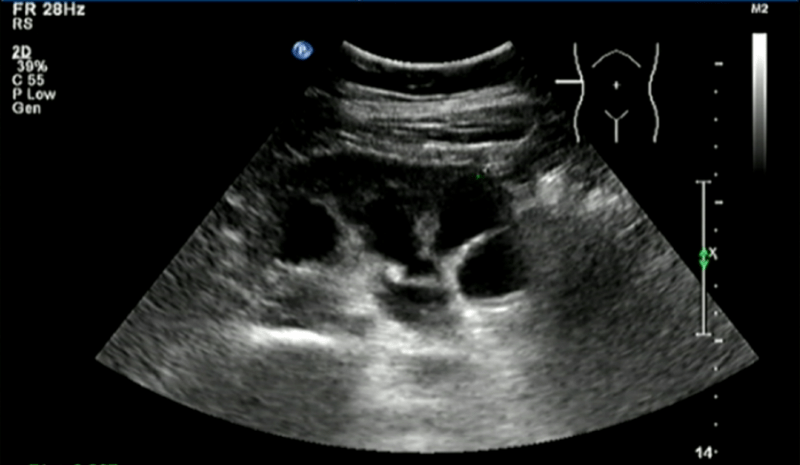 手术|阑尾可“变废为宝”？机器人“巧手”不放支架解决输尿管狭窄