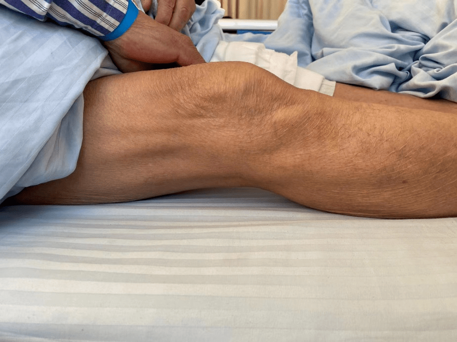 关节屈曲高达140°,接近生正常活动度右膝uka术后两年,张大爷今年74岁