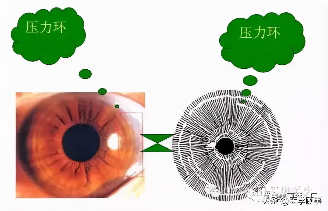 虹膜診斷與五臟六腑的關係_眼睛_腸道_結腸