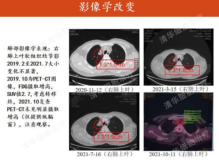 不願在家坐等第三次轉移,腎癌的他這樣選擇