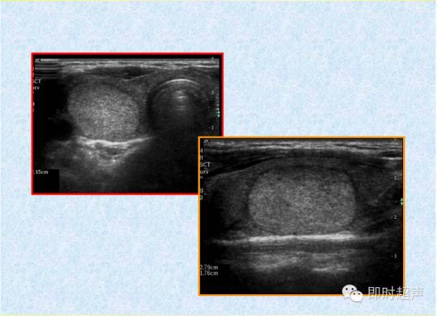 史上最實用甲狀腺超聲診斷有圖有真相