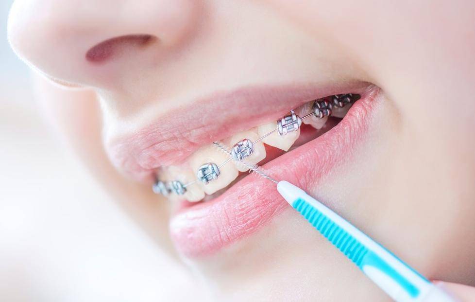 在廊坊,牙齿矫正收缝别急着摘牙套