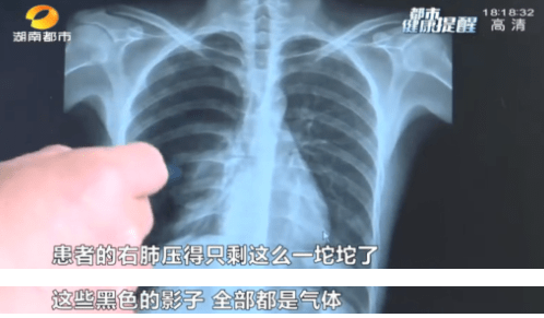 高音|25岁男子唱歌把“肺”唱破送医抢救！医生提醒：多发于瘦高型男性
