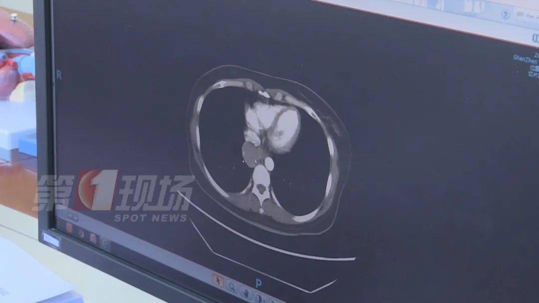 关节|女子手指肿成“萝卜头”，一查竟是癌症！