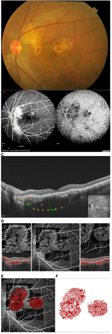 aao中国之声丨魏文斌教授团队海扇状血管网络脉络膜骨瘤肿瘤血管系统
