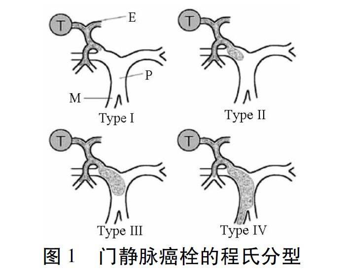 门静脉工字型图片