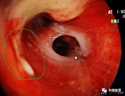 我们对此进行支气管镜检查,镜下可见右肺中叶支气管黏膜有白色分泌物