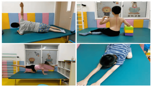 丹东市中医院骨科专家跟您聊聊特发性脊柱侧弯