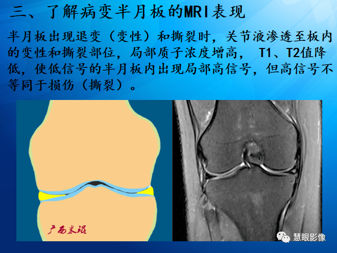 mri半月板損傷基礎