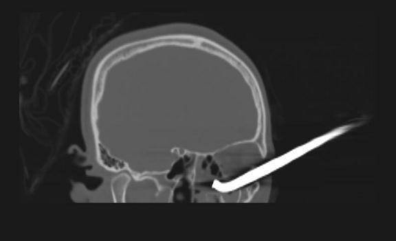 手术|吓人！广西一女子被13cm钢筋扎入眼眶，眼鼻鲜血直流……
