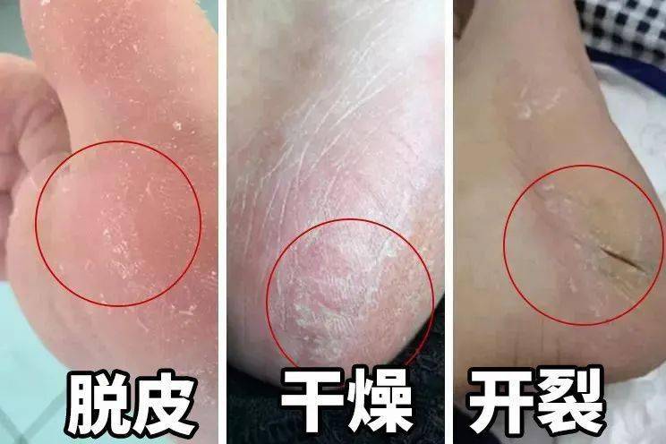 草本植物脚跟开裂、老茧、死皮……又疼又丑！用它一抹，双脚嫩滑，实测惊呆了！