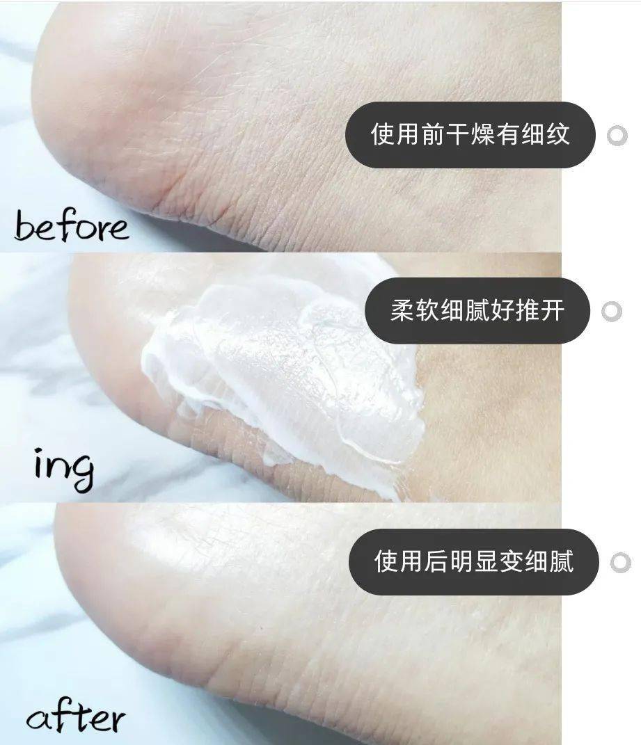 草本植物脚跟开裂、老茧、死皮……又疼又丑！用它一抹，双脚嫩滑，实测惊呆了！