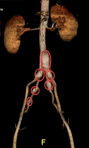 男子|男子体内藏有多枚“不定时炸弹”！医生改装“排雷”工具