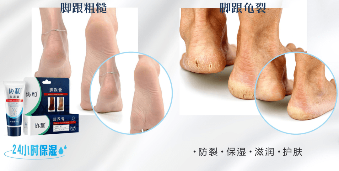 草本植物脚跟开裂、老茧、死皮……又疼又丑！用它一抹，双脚嫩滑，实测惊呆了！