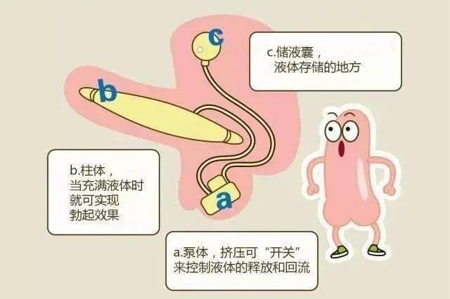 "三件套"一换,解决他的难题_齐先生_阴茎_障碍