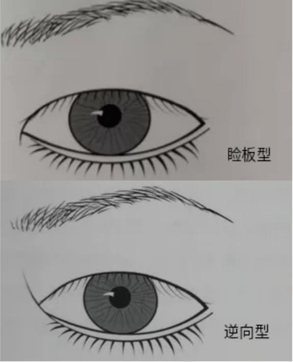 内眦赘皮分类及影响