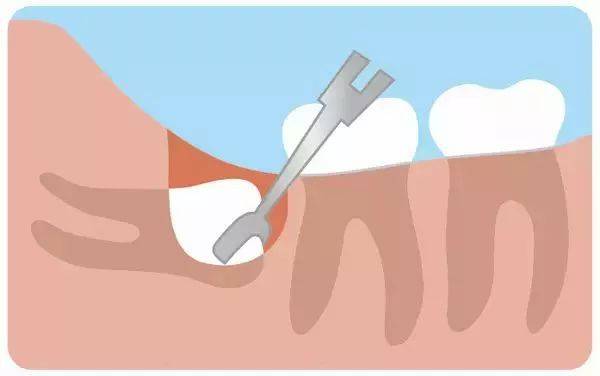 什麼樣的智齒必須拔掉?_牙齒_時間_空間