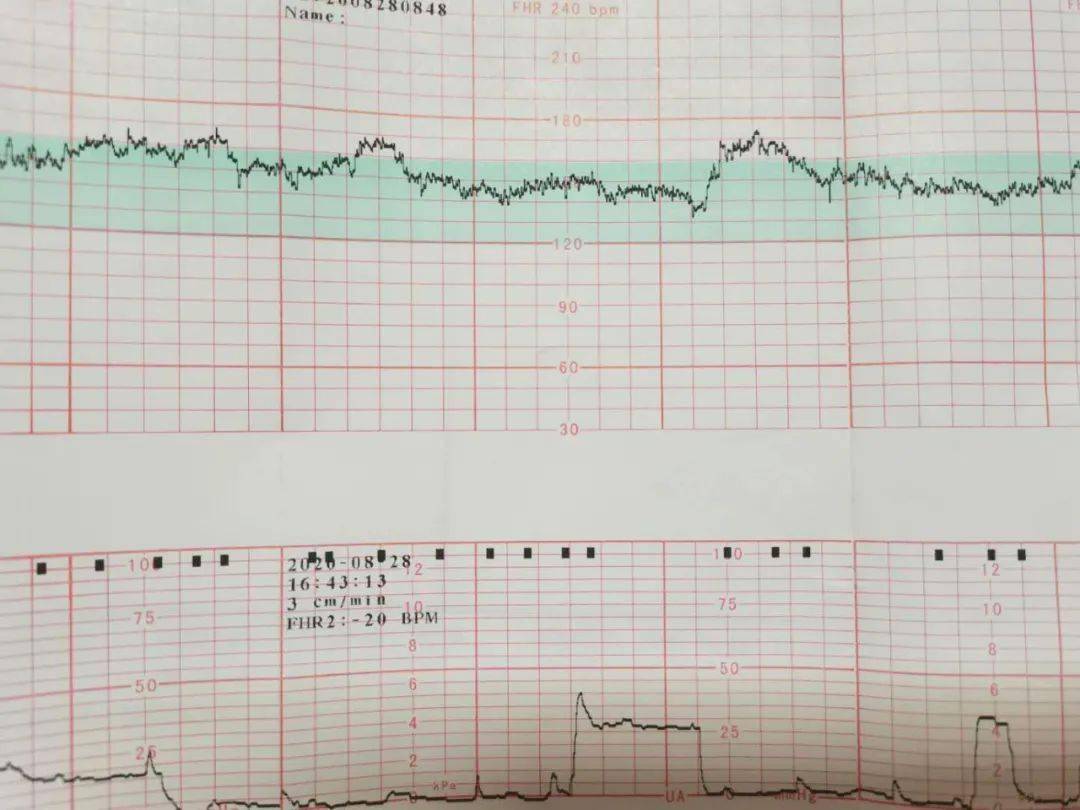 20分钟的胎心监护,总有宝妈过不了,你该掌握些小技巧_宝宝_情况_胎儿