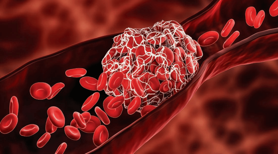 深靜脈血栓形成_風險_血液_症狀