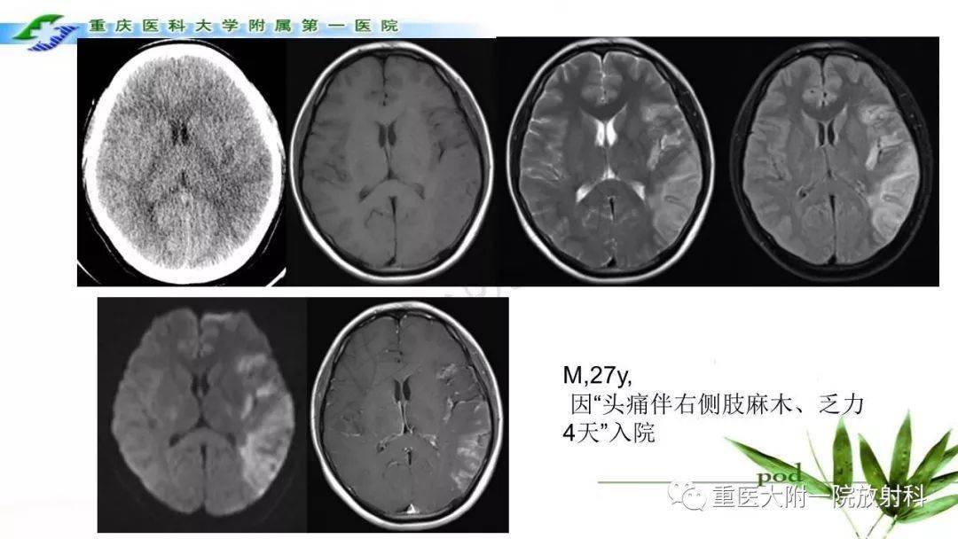 melas型線粒體腦肌病影像診斷及鑑別診斷_全網_解剖圖_系統