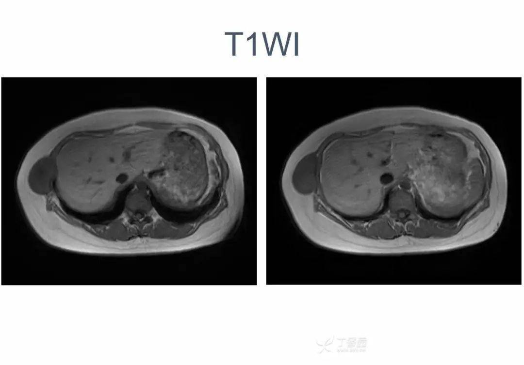 年轻女孩腋下现「鸡蛋大」肿物,究竟是什么?_丁香园_体检_肿块