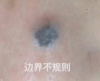 女士|因为脚底一颗小“黑痣”，广东一女子摊上大事了