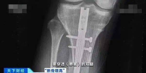 中国|国人的身高焦虑，又卷到了谁